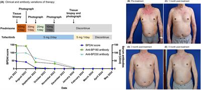 Treatment and molecular analysis of bullous pemphigoid with tofacitinib: a case report and review of current literature